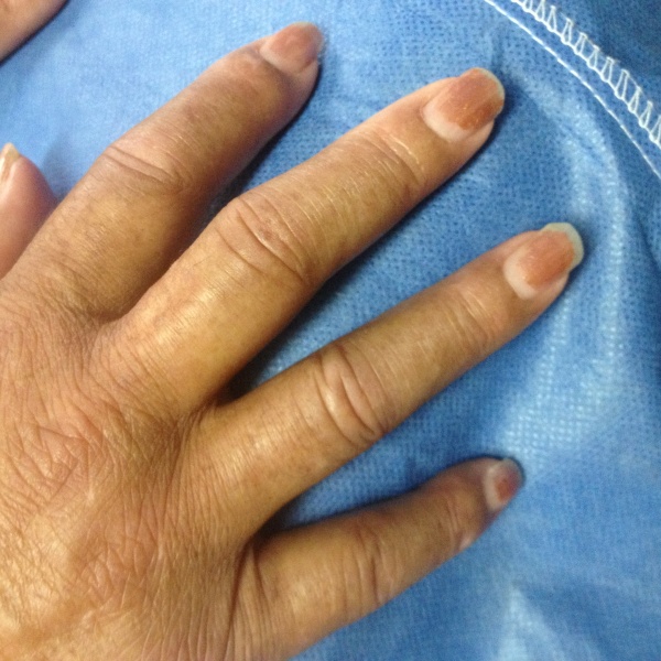 Inflamación y deformidad inicial en artritis reumatoide 